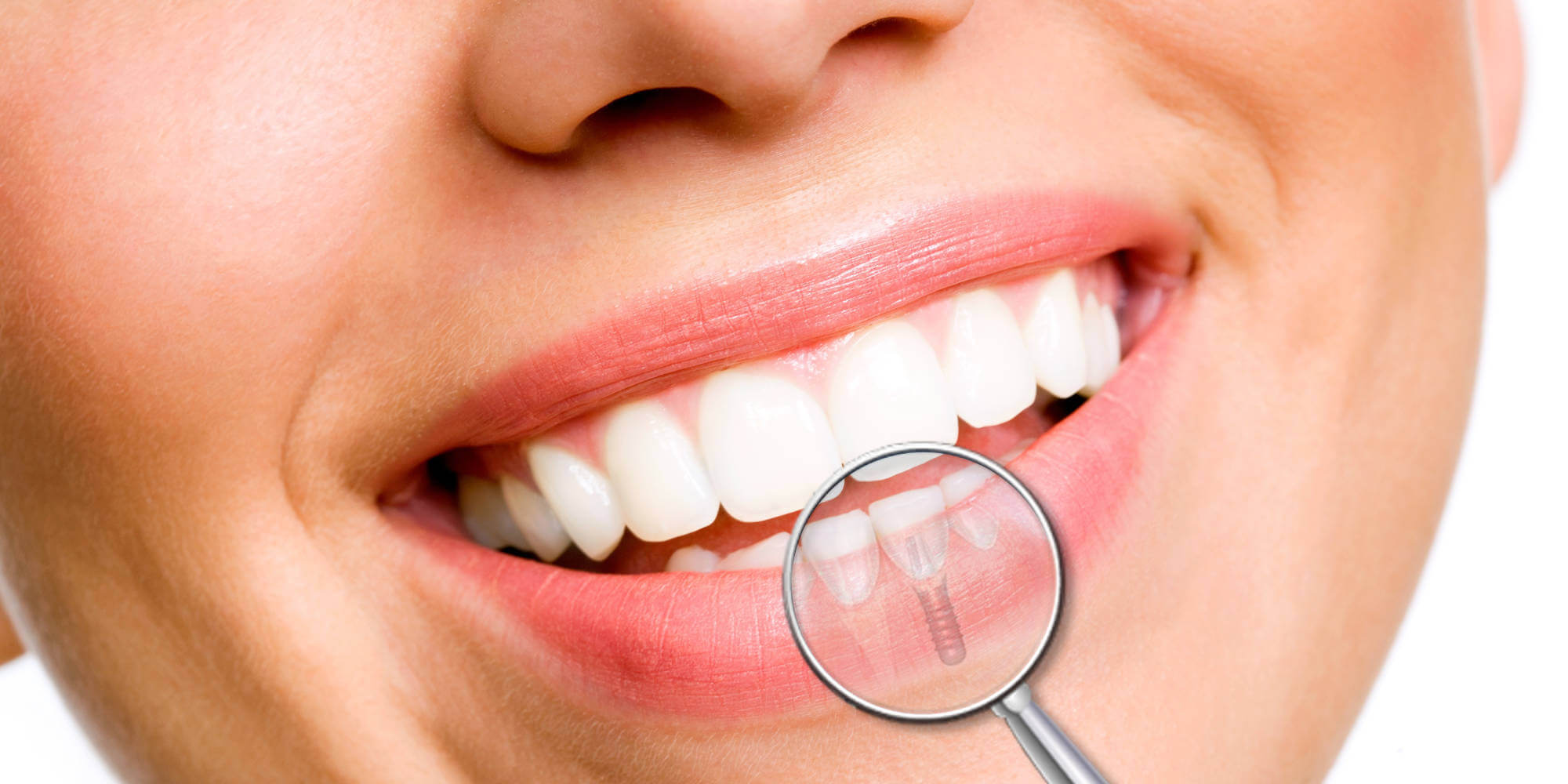 דירוג מרפאות השתלות השיניים הטובות ביותר בסמארה לשנת 2020