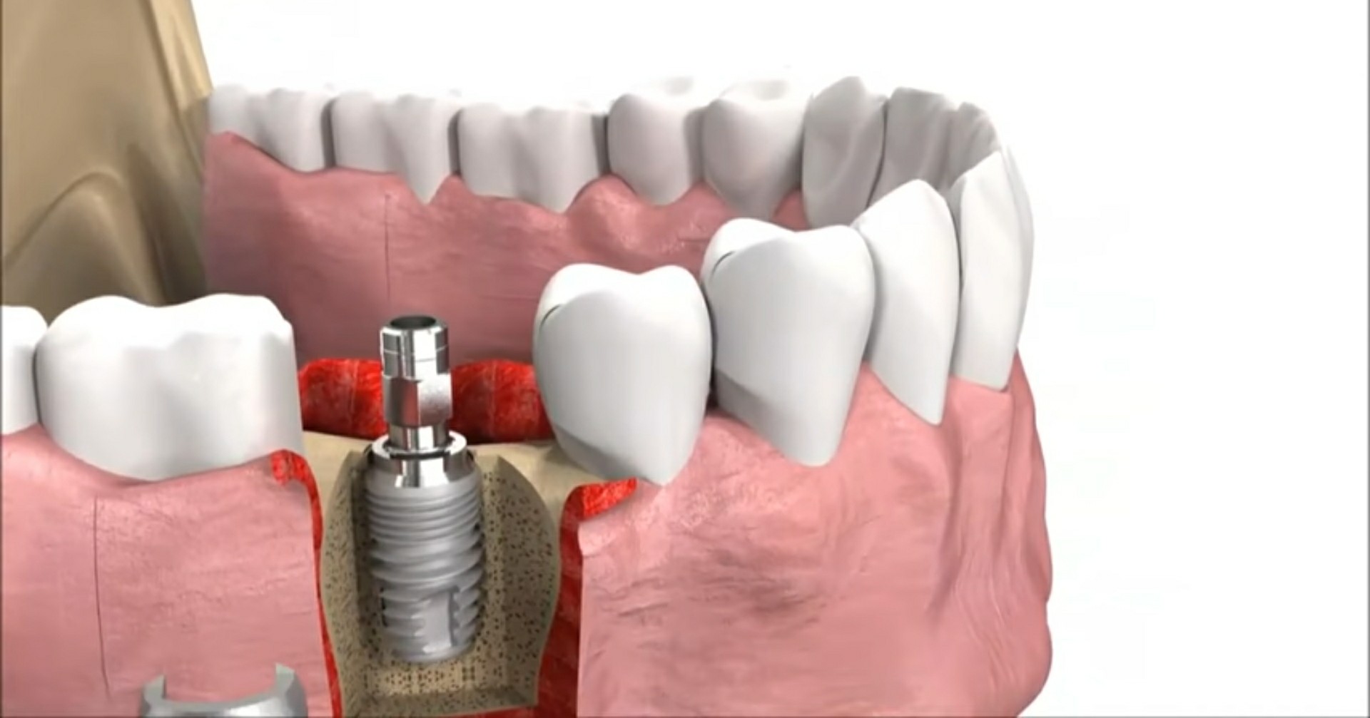 Labāko zobārstniecības implantācijas klīniku vērtējums Kazaņā 2020. gadam