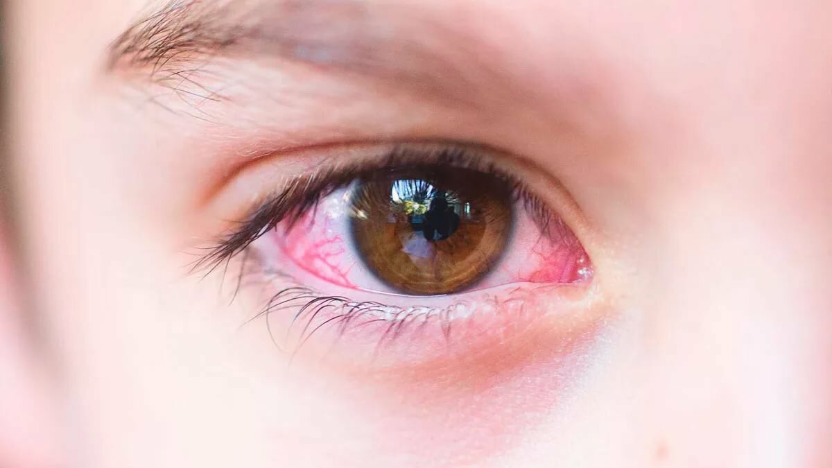 Rating of the best drops for conjunctivitis for 2020