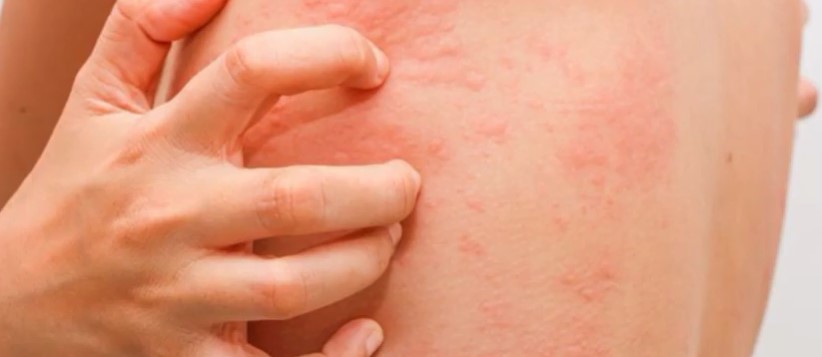 Rating of the best remedies for urticaria for 2020