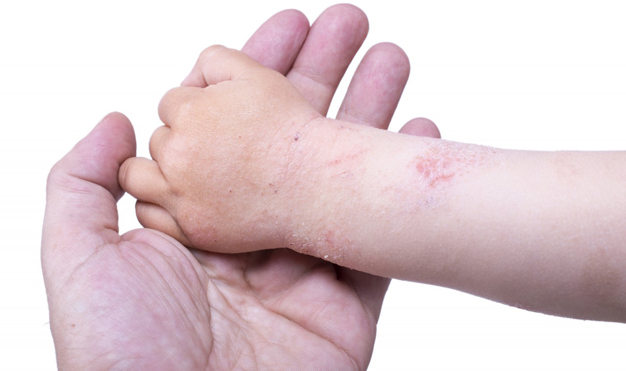 Hodnotenie najlepších krémov na atopickú dermatitídu do roku 2020